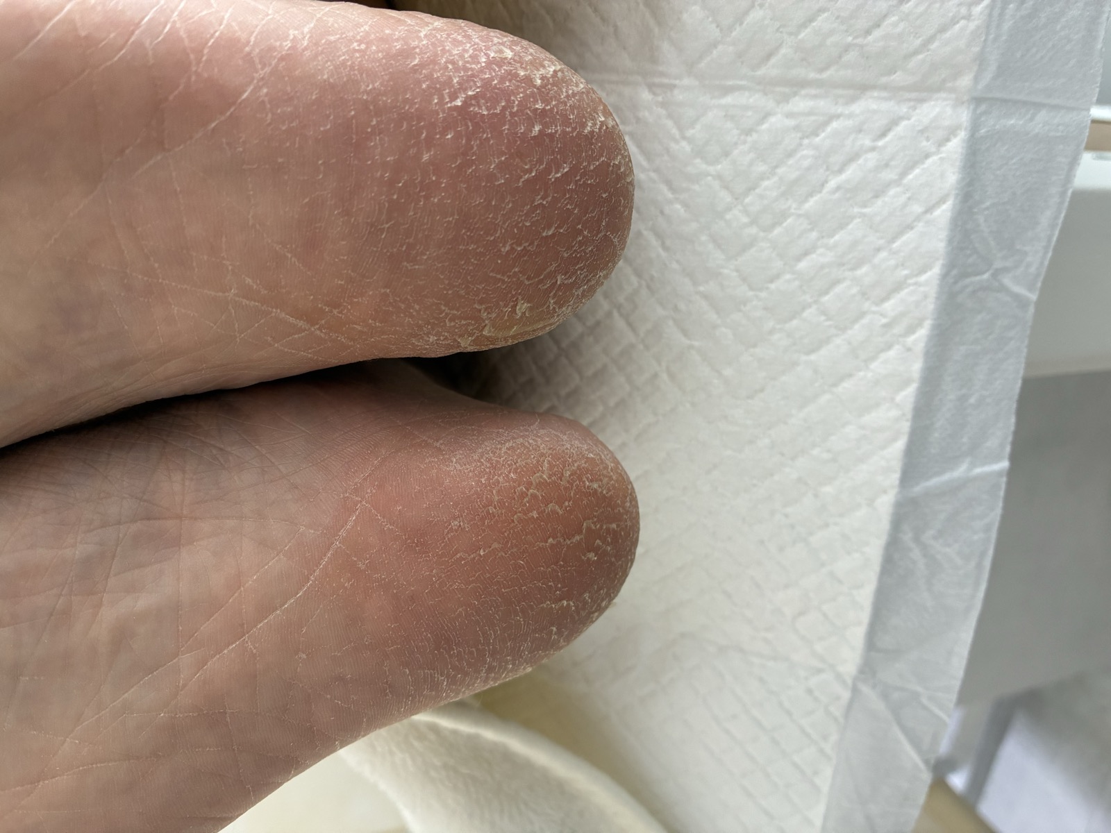 かかと・足裏の角質ケア
