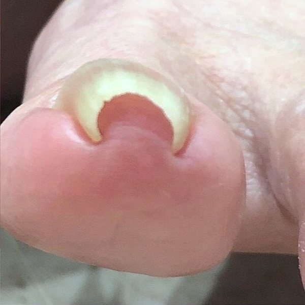 巻き爪の施術前（指先から）