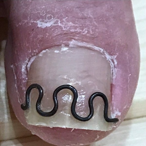 ツメフラ法の装具を付けた状態（上から）