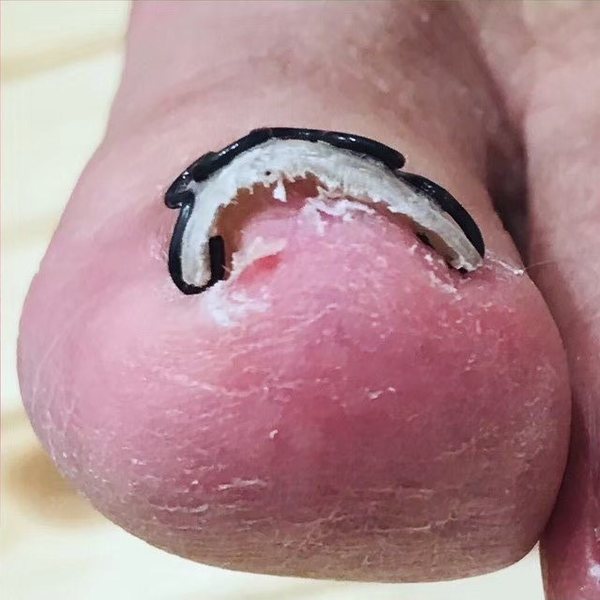ツメフラ法の装具を付けた状態（指先から）