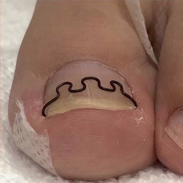 ツメフラ法の装具を付けた状態（上から）