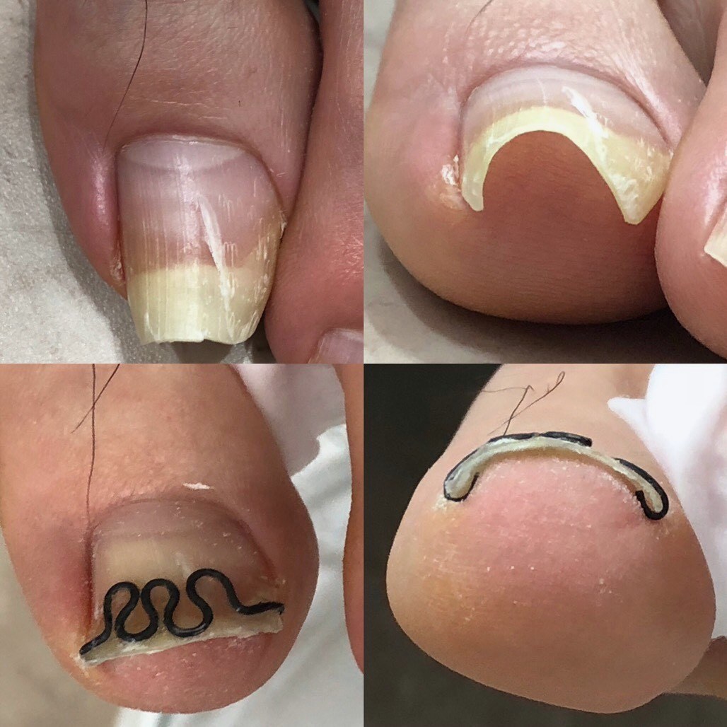 巻き爪ケアのビフォーアフター