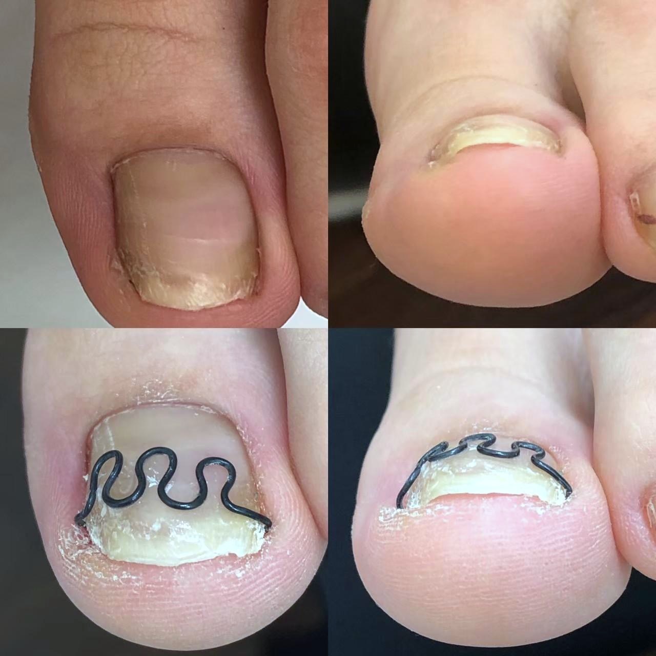 巻き爪ケアのビフォーアフター