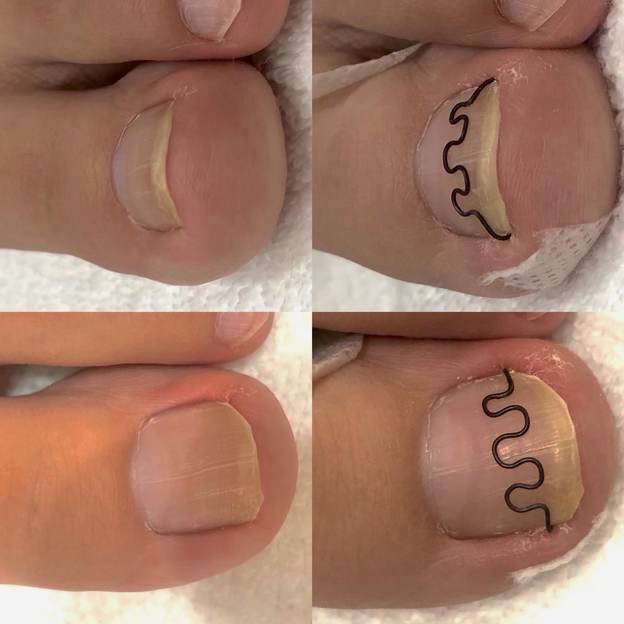 巻き爪ケアのビフォーアフター